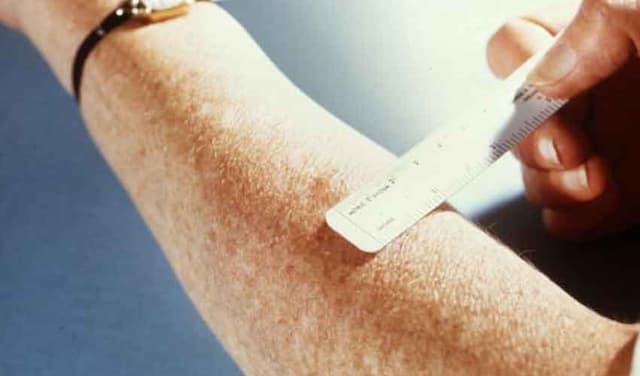 Shortage of modern TB testing kits reported in Pakistan (Courtesy: File)