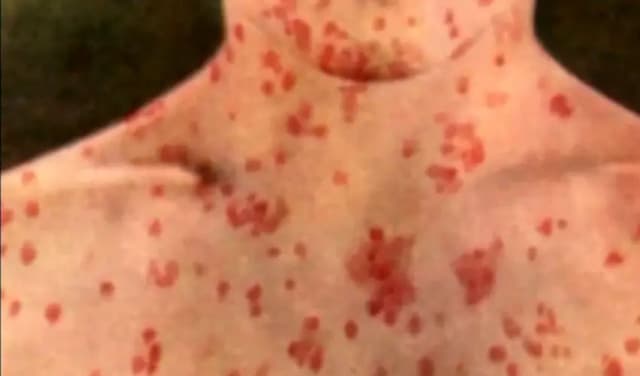 US-measles