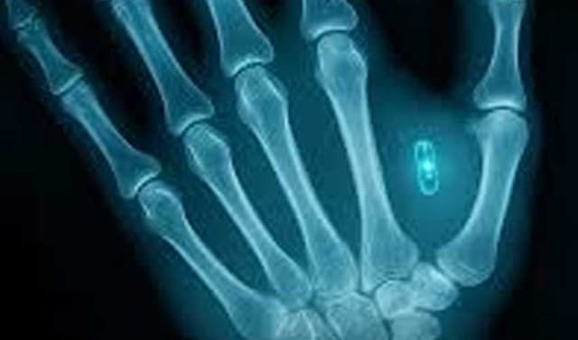 Man in Missouri loses access to chip implanted in his palm after forgetting password (Courtesy: File)
