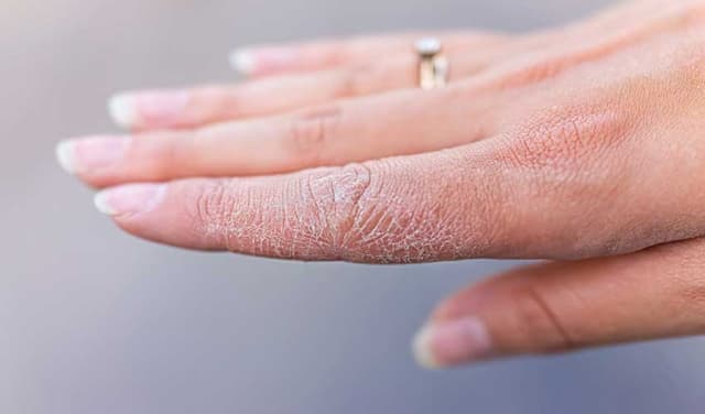 Experts warn excessive hot drinks in winter can dry skin (Courtesy: Online)