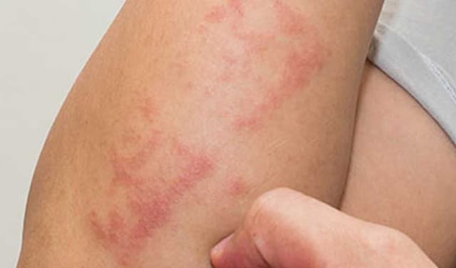 Dermatologists clarify difference between dry skin, eczema (Courtesy: File)