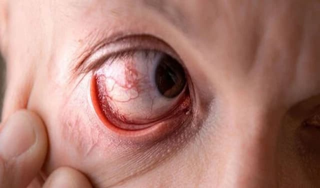 eye-infection-weight-loss