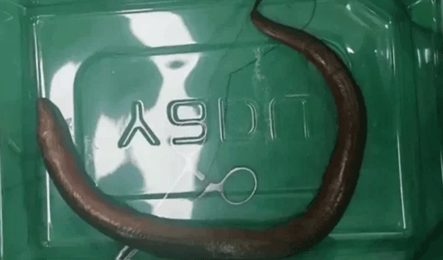 Man found with live eel in abdomen (Courtesy: File)