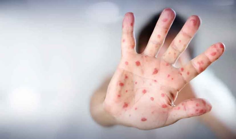 53 children die from measles in Sindh this year (Courtesy: File)