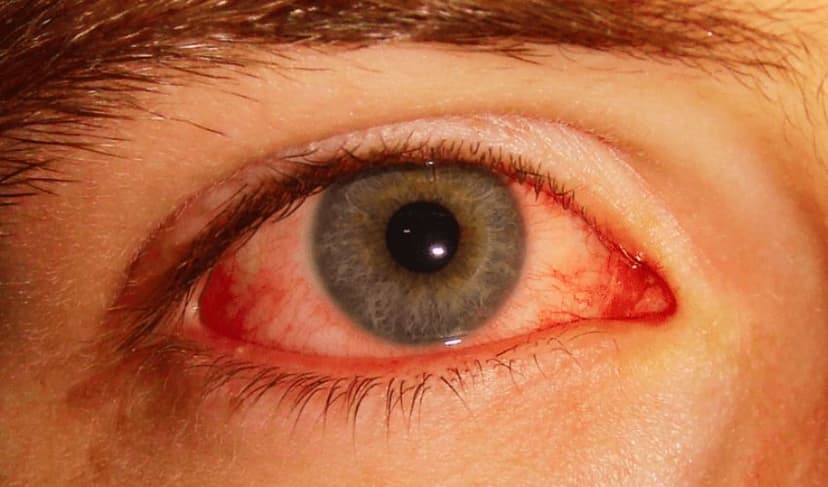 Pink eye
