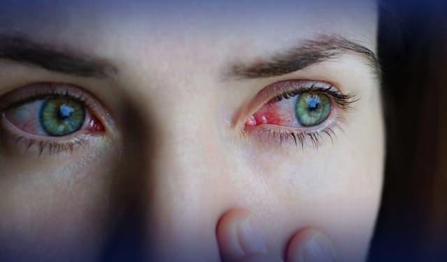 Pink eye threat looms in Punjab – File