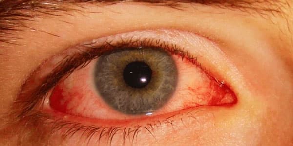 Pink eye infection File