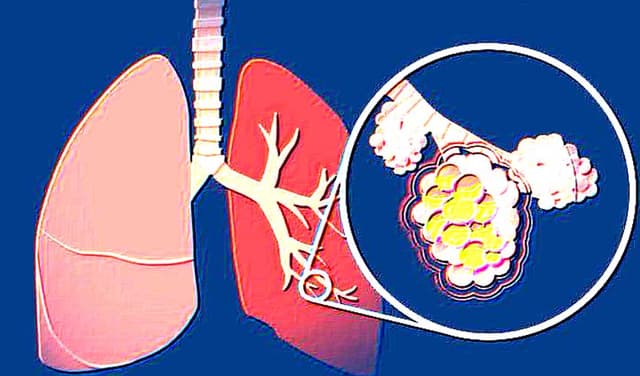 Eight children succumbed to pneumonia in last 24 hours – File