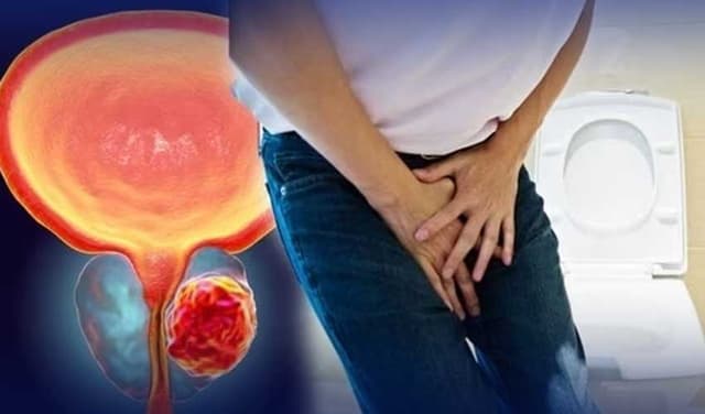 Prostate cancer