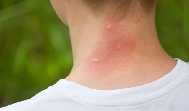 skin-diseases-in-summer