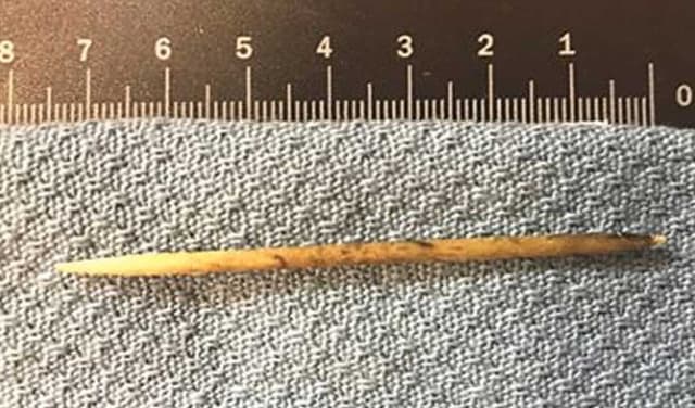 Doctors remove 9-inch toothpick from elderly patient’s oesophagus in rare surgery (Courtesy: Online)