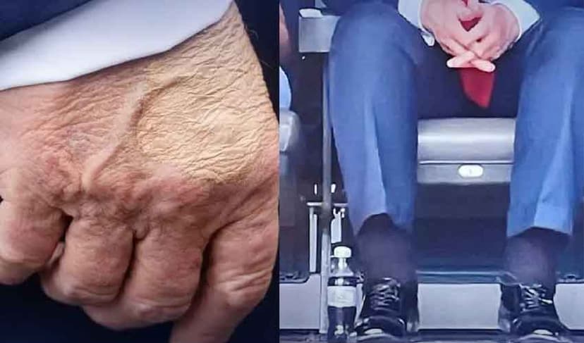 Trump bruise and swelling
