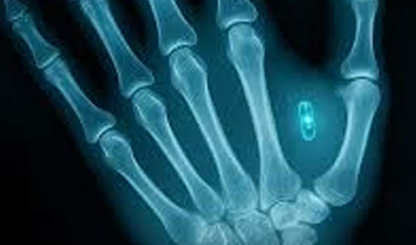 Man in Missouri loses access to chip implanted in his palm after forgetting password (Courtesy: File) Man in Missouri loses access to chip implanted in his palm after forgetting password (Courtesy: File)