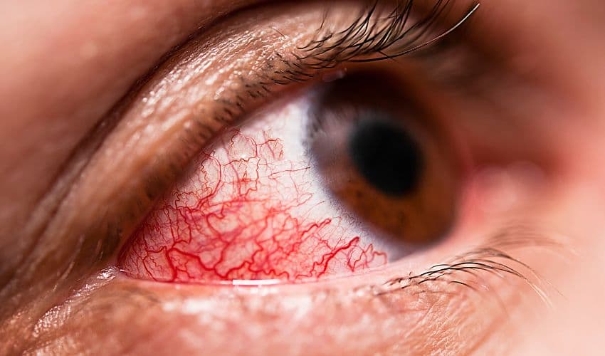 Conjunctivitis Conjunctivitis