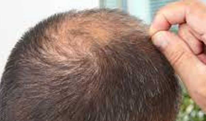 Unlicensed hair transplant clinic shut down in Dubai apartment (Courtesy: Representational Image) Unlicensed hair transplant clinic shut down in Dubai apartment (Courtesy: Representational Image)