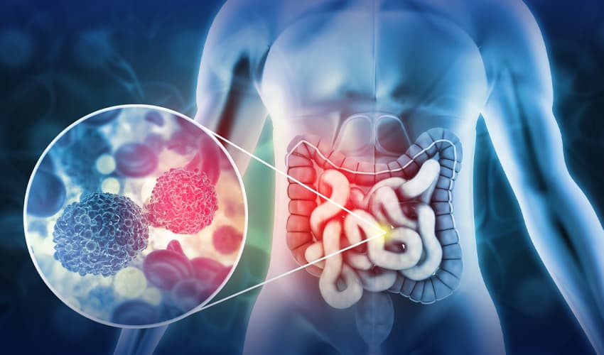 hidden colon cancer risks uncovered! hidden colon cancer risks uncovered!