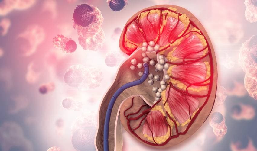 Kidney stones Kidney stones