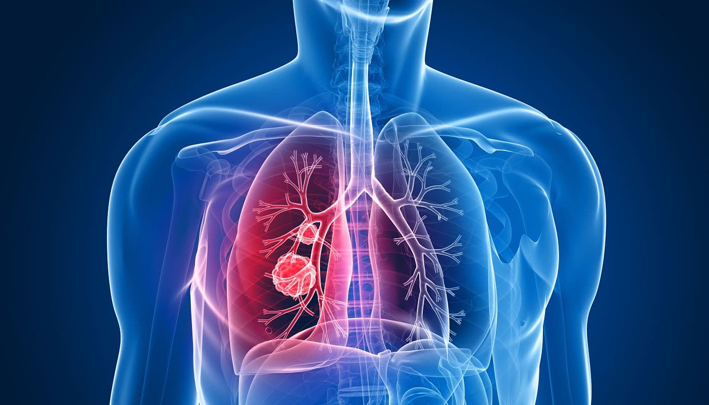 lung cancer lung cancer