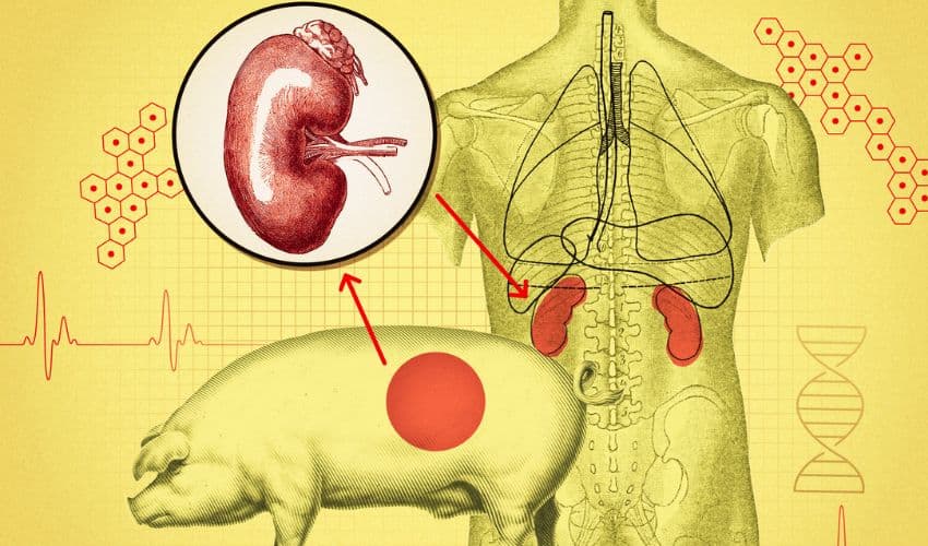 Pig to human transplant Pig to human transplant