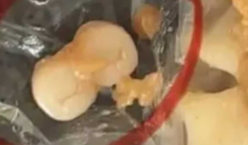 Human teeth found in food items spark anger across China (Courtesy: Online) Human teeth found in food items spark anger across China (Courtesy: Online)