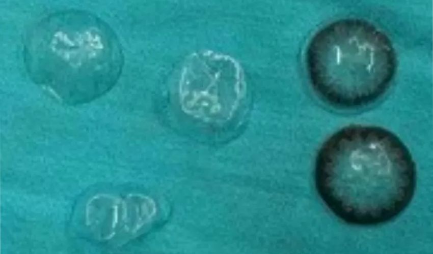 Doctors discover 5 lost contact lenses behind woman’s eyeball