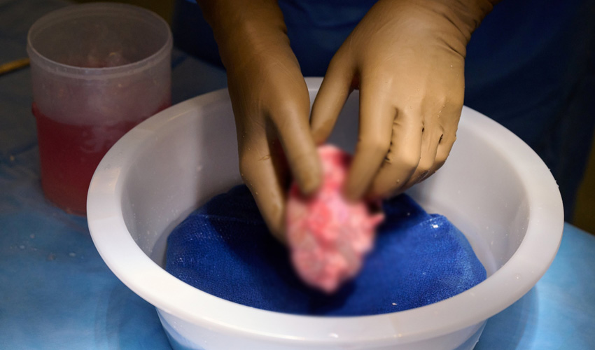 First ever living human receives Pig kidney transplant successfully