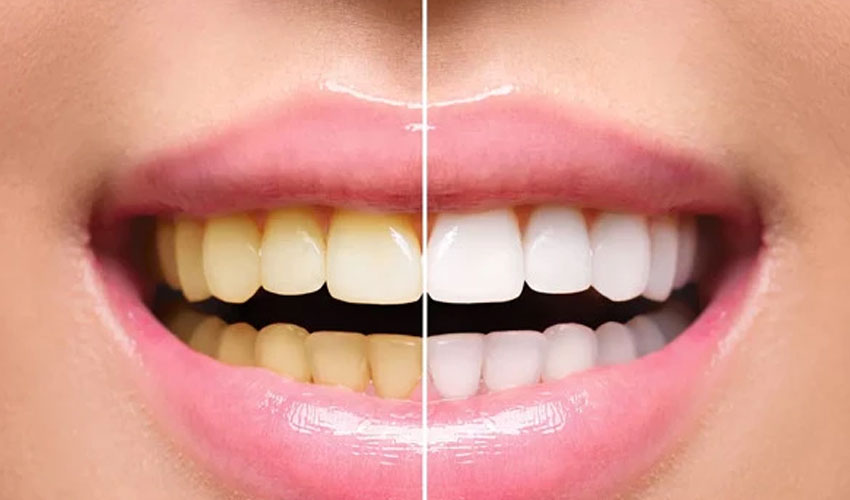 Teeth whitening powders: Are they safe and effective?